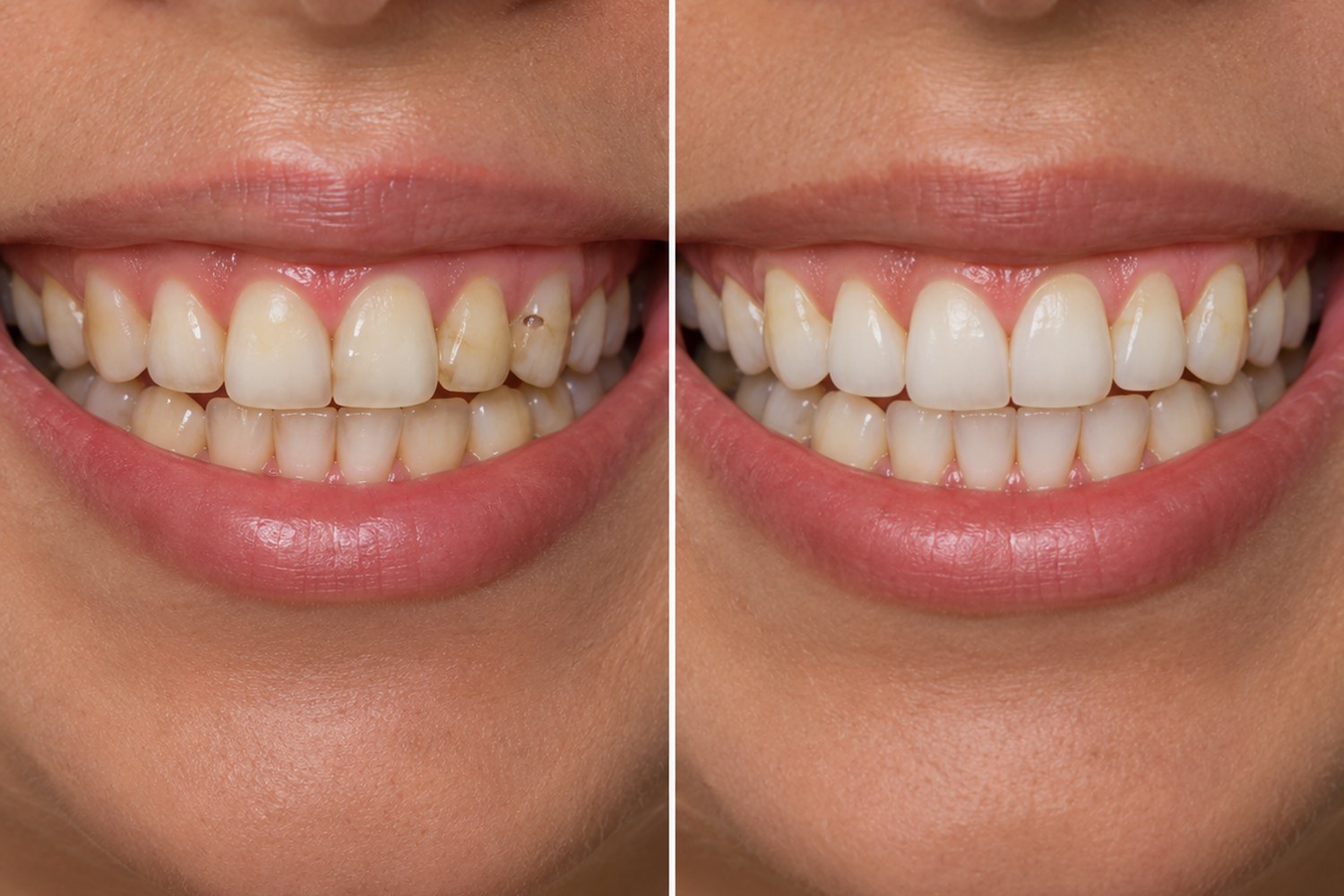 Comparativo antes e depois de restaurações e clareamento dental