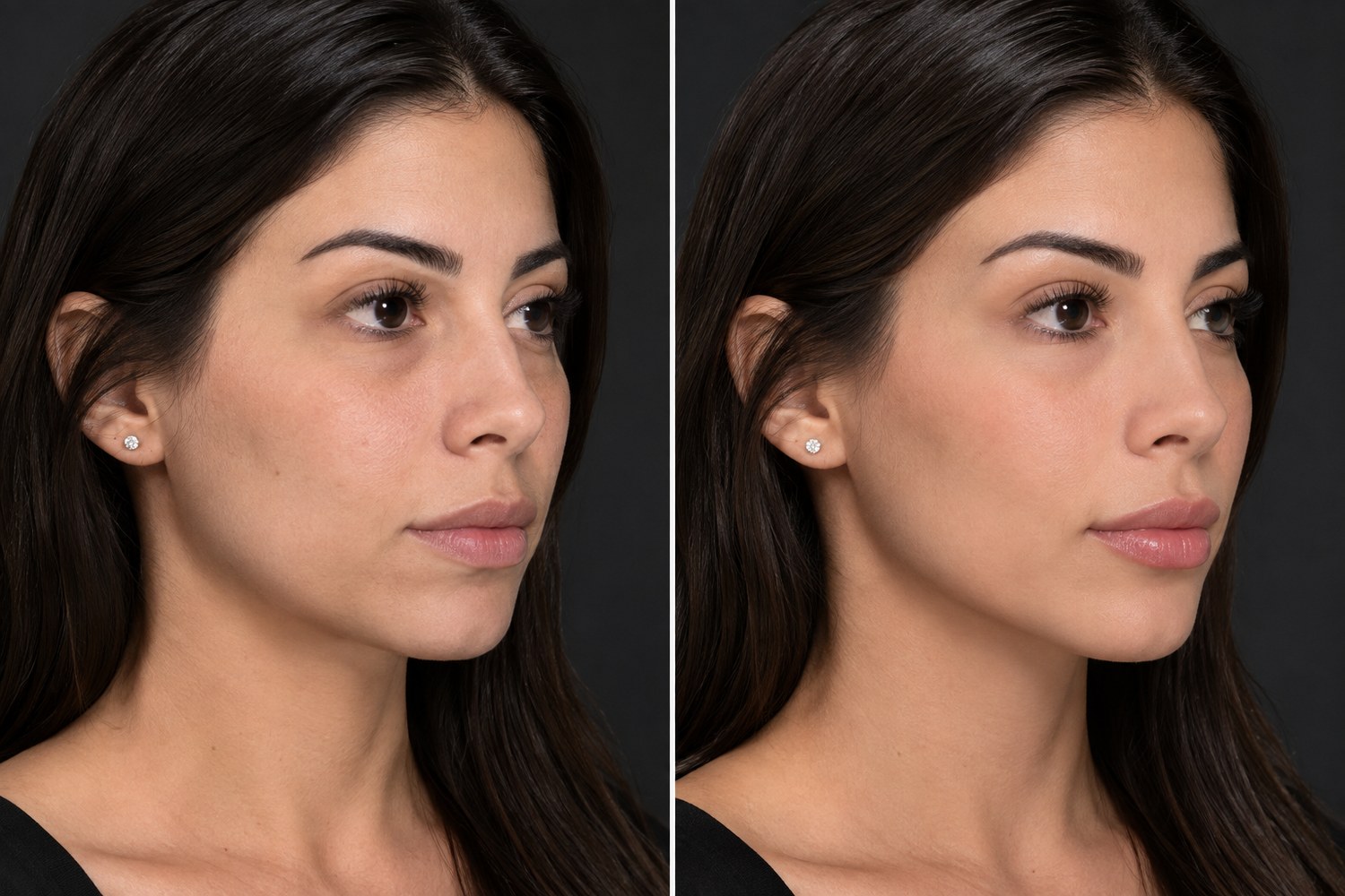 Comparativo antes e depois de harmonização facial